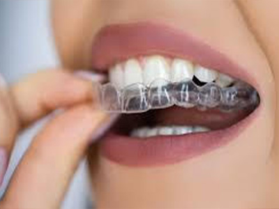 Valley Dental Esthetics | Invisalign reg , Dentures and Dental Fillings