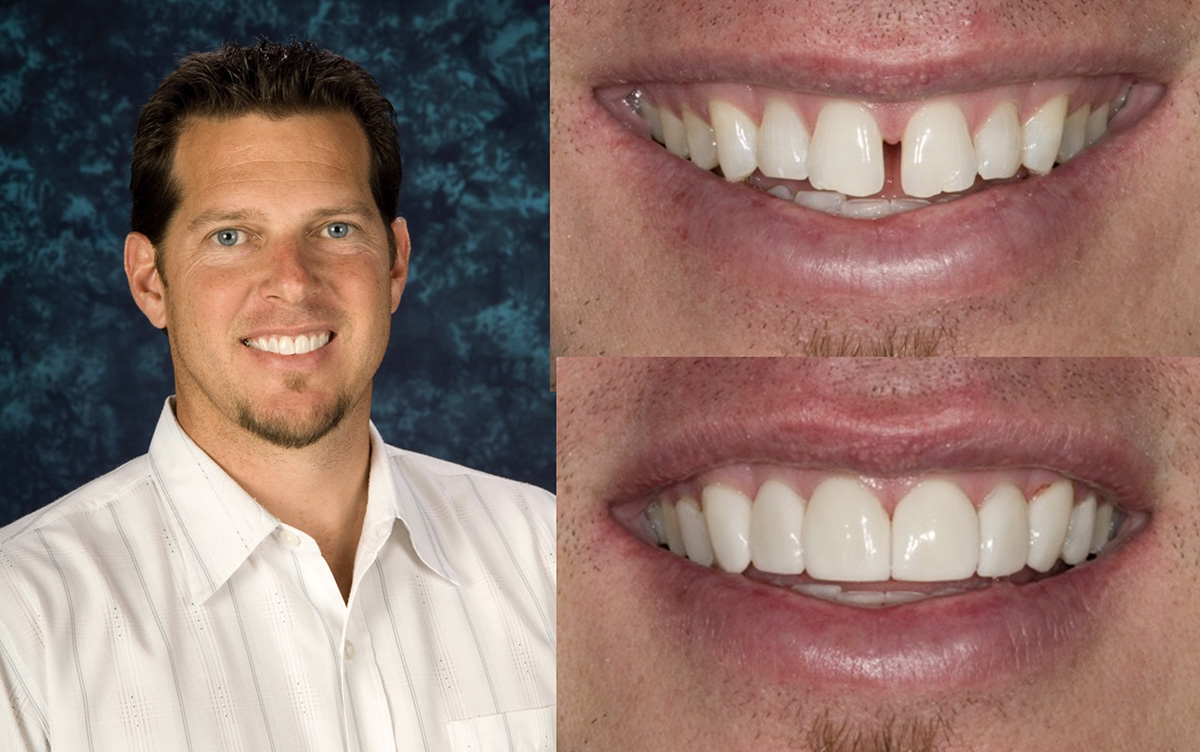 A smiling man with a white shirt, showcasing a dental implant and teeth whitening.
