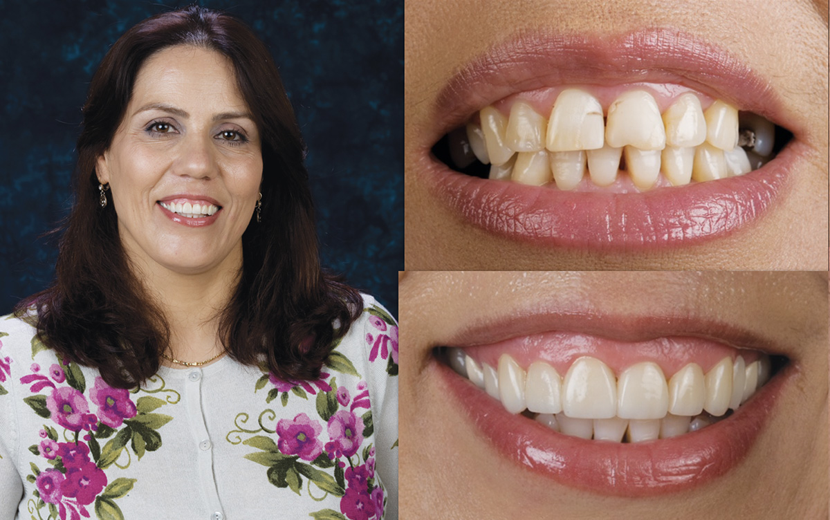 The image shows a person smiling broadly with a set of straight teeth, displaying an improvement in oral health.