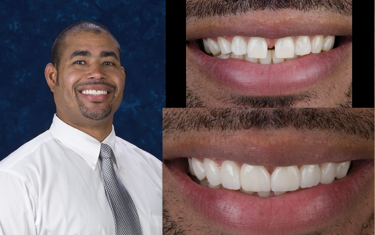 The image shows a person smiling with their teeth, overlaid on a background that includes the same individual s face in three different states of openness.