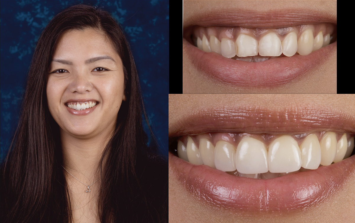 A woman smiling with a close-up of her teeth and lips, showcasing her dental care result.