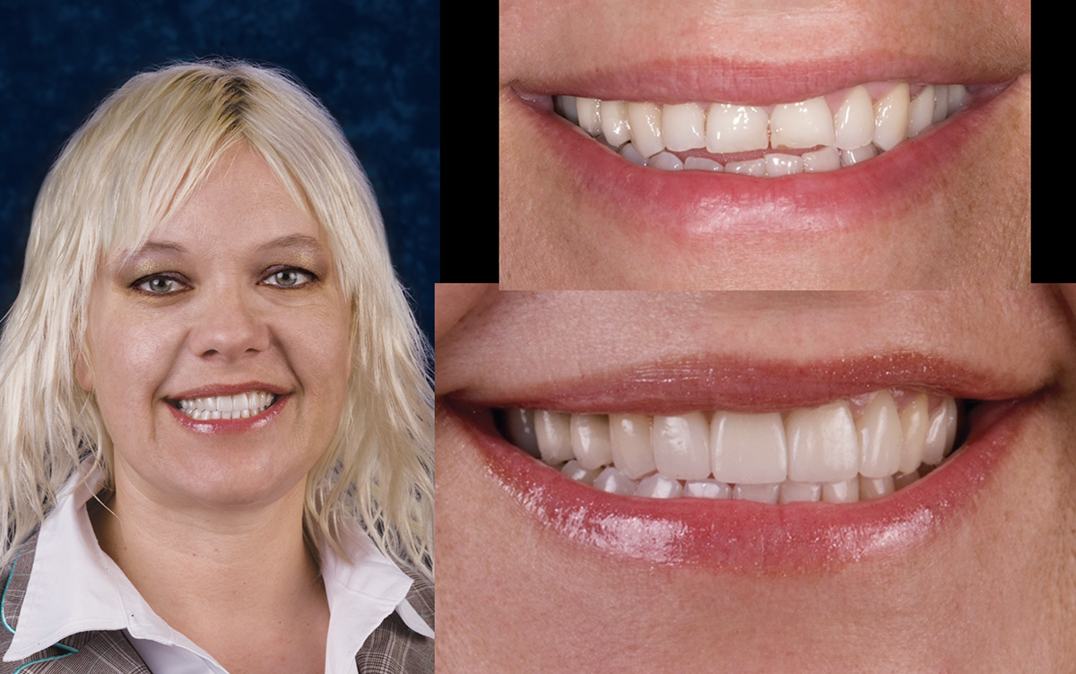 A woman with blonde hair smiling broadly, showcasing her teeth and lips.