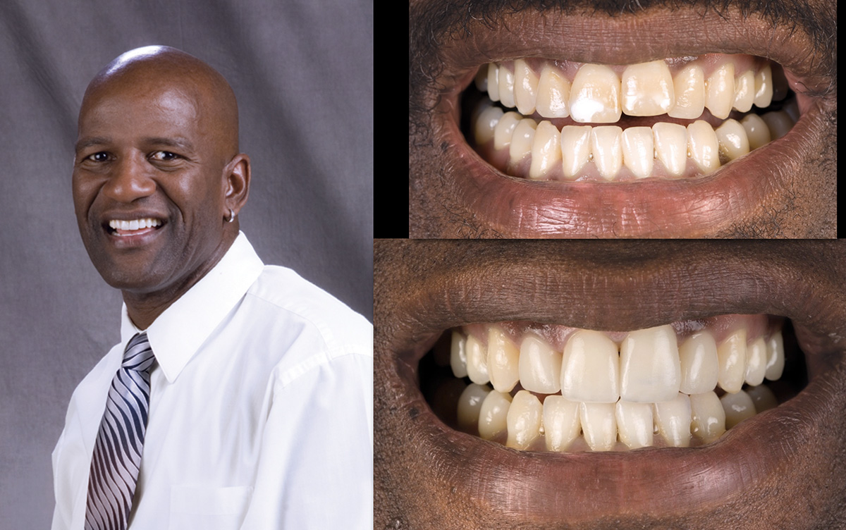 A man with a wide smile, showcasing his dental implants and teeth whitening.