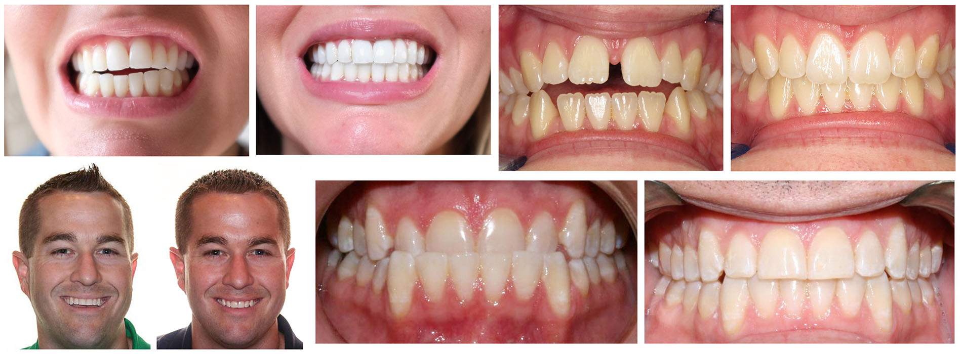 Valley Dental Esthetics | Dentures, Teeth Whitening and Dental Sealants