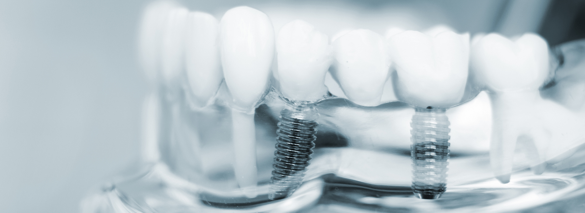 The image features a close-up of dental implants, showcasing the intricate design and structure of the artificial teeth.