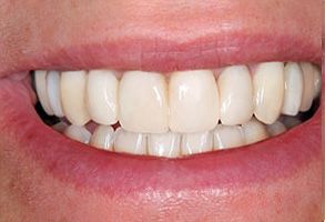The image shows a close-up of a person s smile, revealing white teeth and gums.