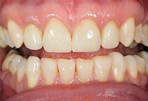The image shows a close-up of a person s teeth with an exaggerated smile, highlighting the yellowish discoloration on the teeth.