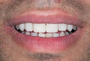 The image shows a close-up of a person s smiling mouth with white teeth, and the person has facial hair.