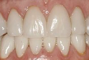 The image displays a close-up of a person s teeth, showcasing a smile with a mix of natural and dental implant teeth.