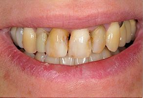Valley Dental Esthetics | Preventative Program, Sports Mouthguards and Dental Bridges