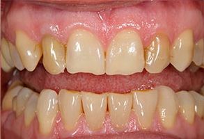 The image shows a close-up of a person s teeth with a focus on the upper front teeth, which appear to be a cosmetic dental work case, possibly for orthodontic treatment or implants.