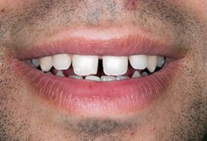 The image shows a close-up of a person s smile with teeth, lips, and a portion of facial hair visible.