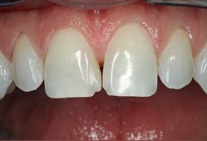Dental implant with a white crown and surrounding teeth, showcasing a partial smile.